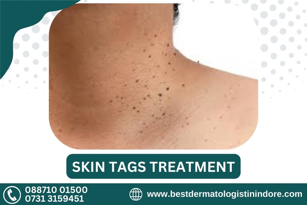 Best Skin Tags Removal Specialist in Indore